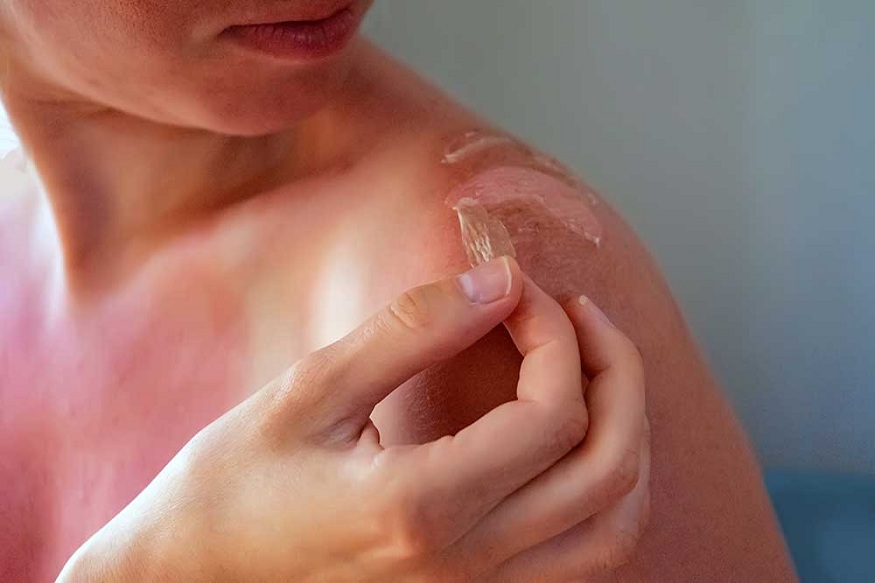 Dermatologists Aid In Sunburn Treatment